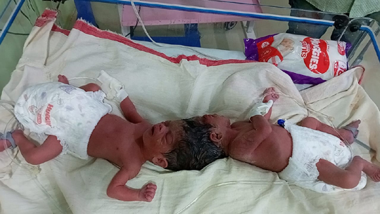 Women gives birth to conjoined twins